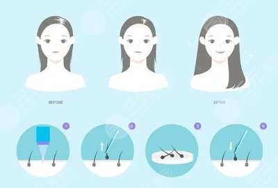 東莞人民醫(yī)院植發(fā)價(jià)位表與頭皮護(hù)理用品一覽